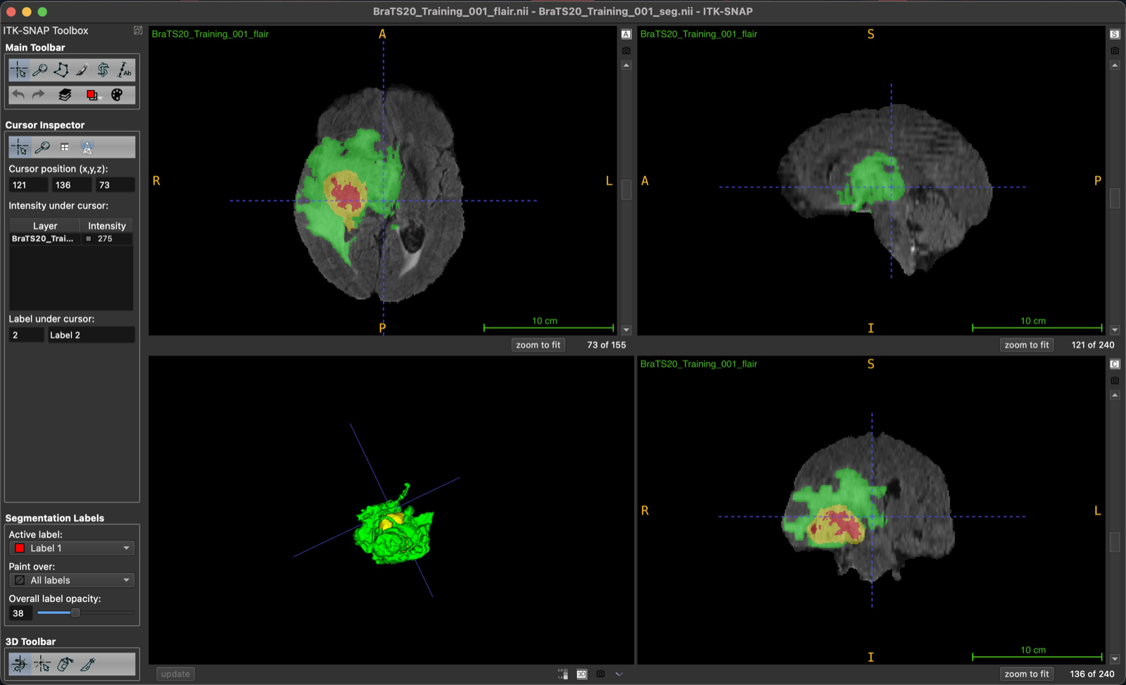 Brain MRI tumor segmentation output